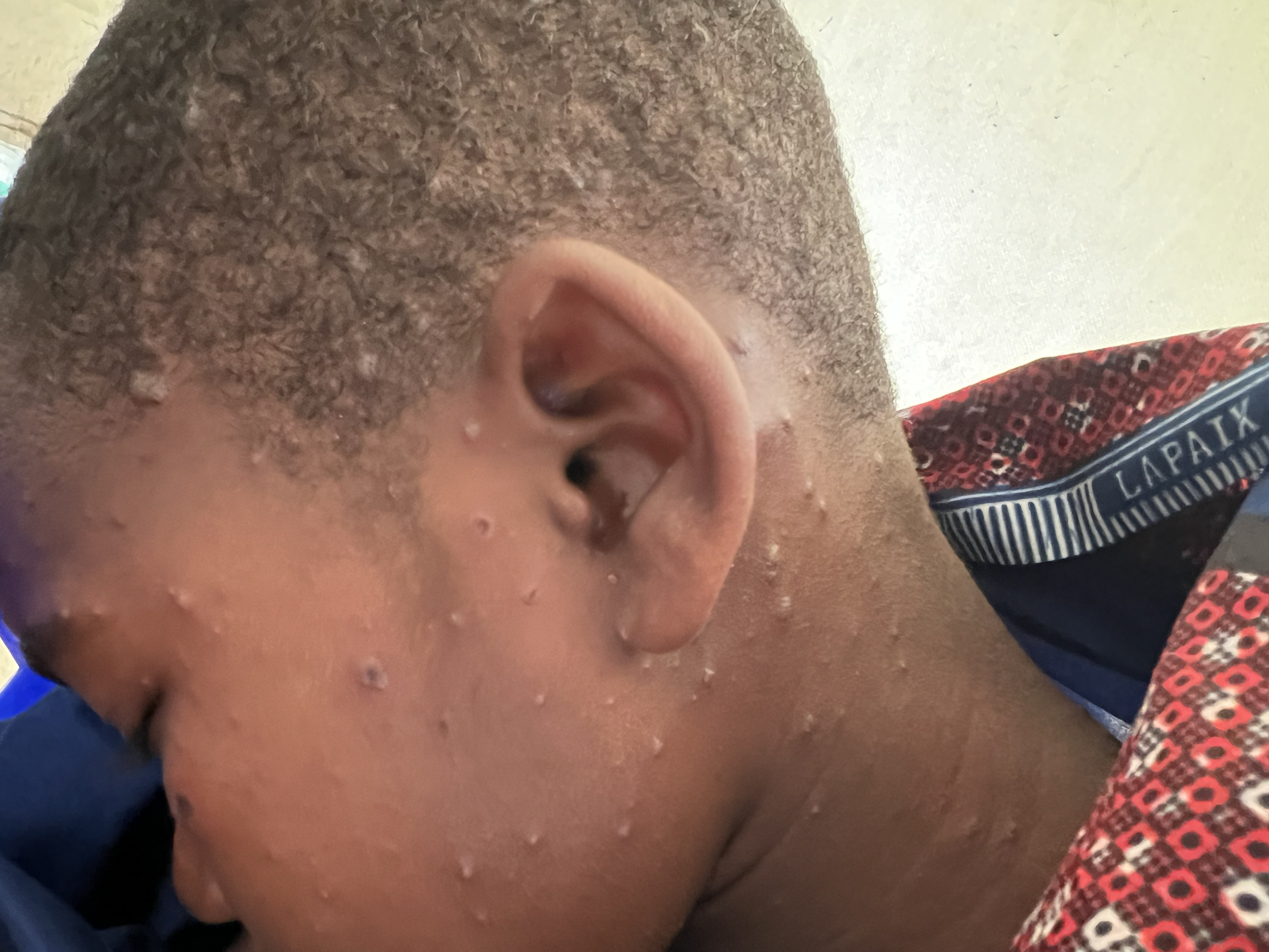 An adolescent child with Mpox waits outside a hospital in Democratic Republic of Congo for treatment.  