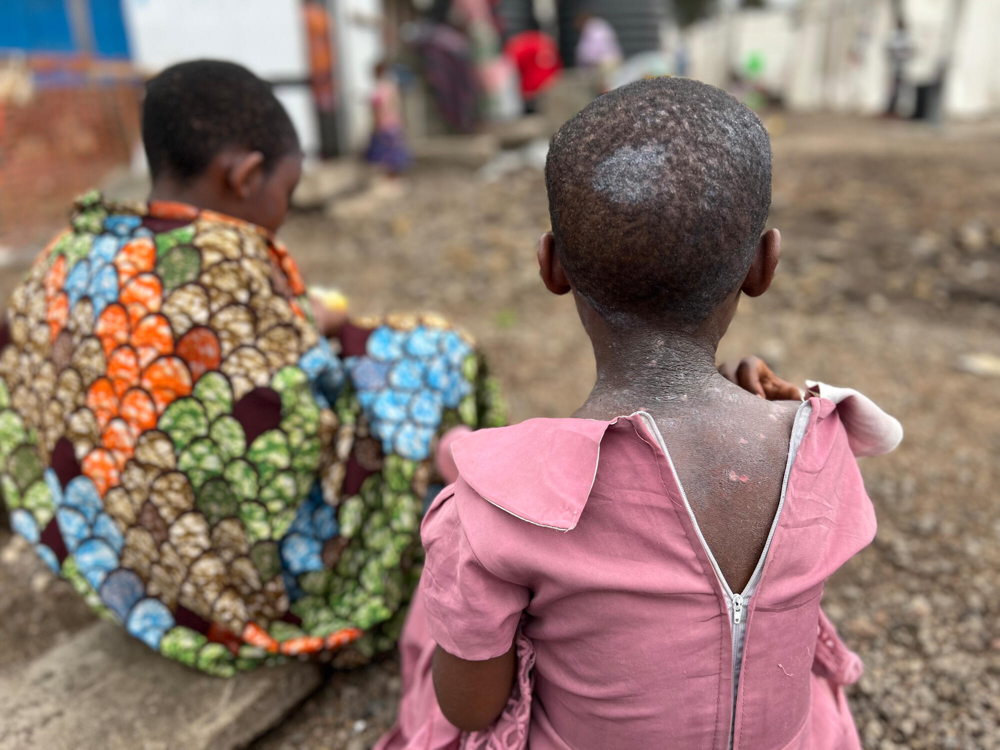 Two school-aged children sit on the ground outdoors. One has scabs on her back. 